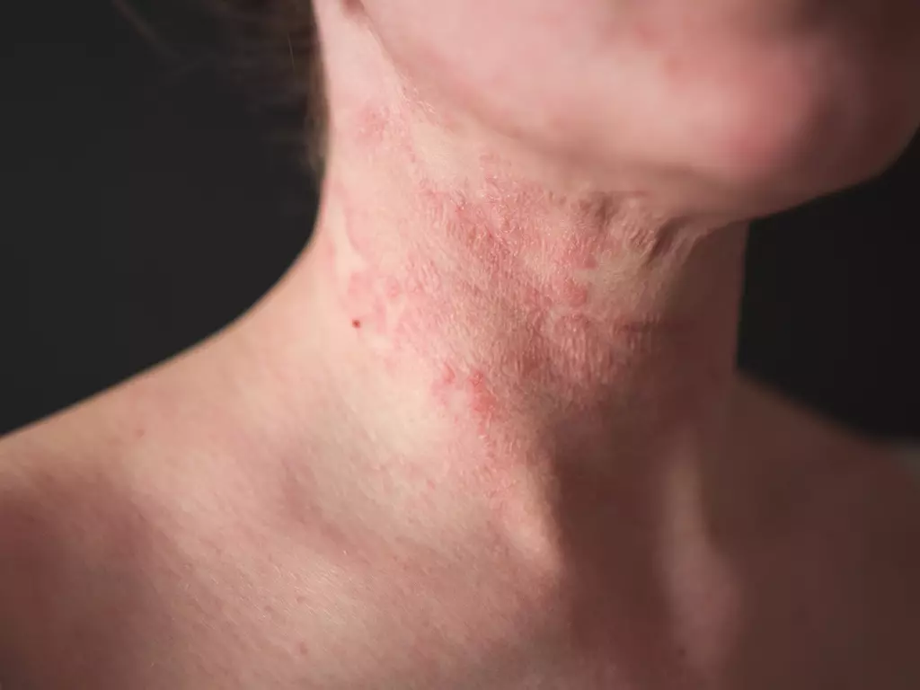 Living With Chronic Eczema a Gentle Ayurvedic Perspective for Long-Term Relief 