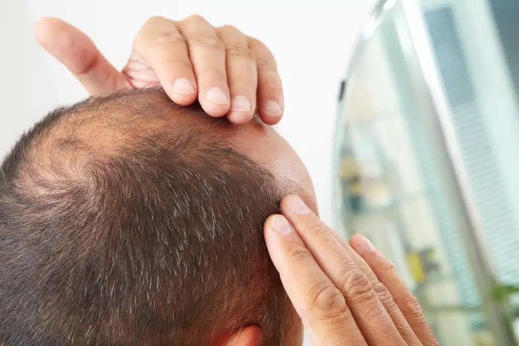 Hair Transplant After Effects – What to Expect